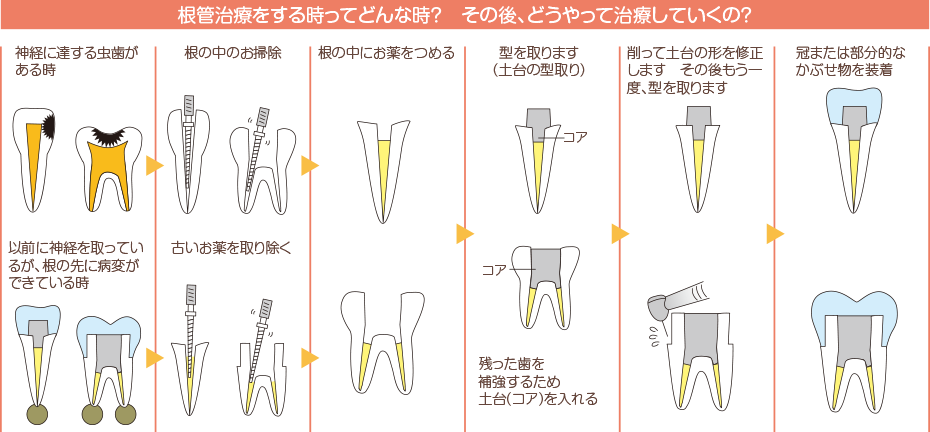 根管治療をする時ってどんな時？その後、どうやって治療していくの？神経に達する虫歯がある時以前に神経を取っているが、根の先に病変ができている時根の中のお掃除古いお薬を取り除く根の中にお薬をつめる型を取ります（土台の型取り）残った歯を補強するため土台（コア）を入れる削って土台の型を修正しますその後もう一度、型をとります冠または部分的な被せ物を装着