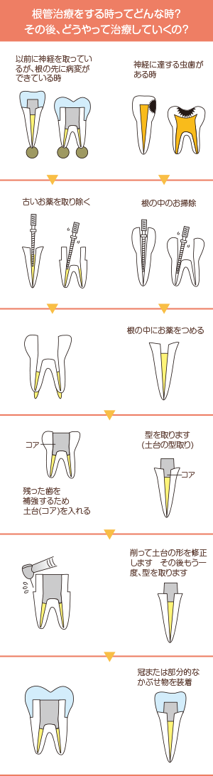 根管治療をする時ってどんな時？その後、どうやって治療していくの？神経に達する虫歯がある時以前に神経を取っているが、根の先に病変ができている時根の中のお掃除古いお薬を取り除く根の中にお薬をつめる型を取ります（土台の型取り）残った歯を補強するため土台（コア）を入れる削って土台の型を修正しますその後もう一度、型をとります冠または部分的な被せ物を装着
