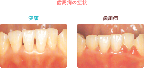 歯周病の症状