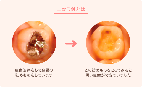 二次う蝕とは, 虫歯治療をして金属の詰めものをしています, この詰めものをとってみると黒い虫歯ができていました